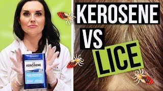 Kerosene For Head Lice Removal  Watch BEFORE YOU TRY [upl. by Hcurab311]