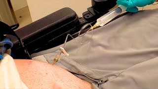 Quadriplegic Refills His Baclofen Pump [upl. by Acirahs]