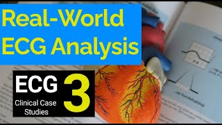 RealWorld ECG Analysis 3 Clinical Case Studies in Electrocardiography [upl. by Lachlan986]