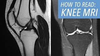 How to Read an MRI of the Knee An Introductory Approach [upl. by Amari]