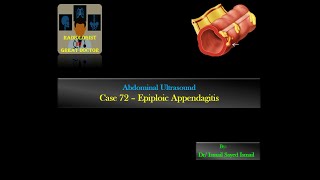 Ultrasound Case 72  Epiploic Appendagitis [upl. by Kirat821]