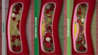 ATHEROSCLEROSIS and CARDIOVASCULAR DISEASE [upl. by Hilton]