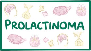 Prolactinoma  causes symptoms diagnosis treatment pathology [upl. by Ulysses]