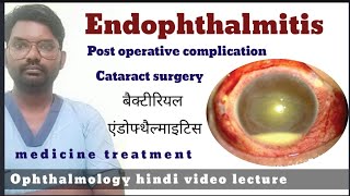 endophthalmitis  endophthalmitis treatment  endophthalmitis  endophthalmitis disease [upl. by Akinit]