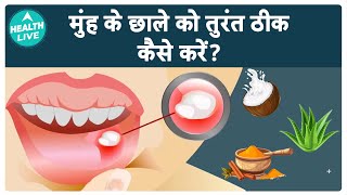 Mouth Ulcers को कैसे Treat करें  Ulcer  Health Live [upl. by Amri]