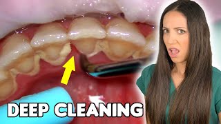 Deep Cleaning With HEAVY Tartar Build Up At The Dentist [upl. by Kcirrez]