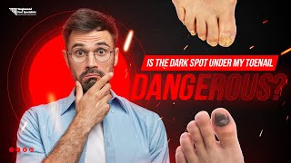 Is the Dark Spot Under My Toenail Dangerous [upl. by Notsuj]