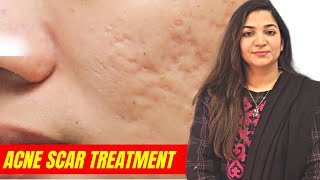 How To Treat Acne Scars  Acne Scar Treatment by Dr Aisha Ghias acne acnescars [upl. by Fahland]