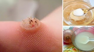 How to Get Rid of Warts Naturally [upl. by Junia]