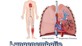 Lungenembolie  Krankheiten der Blutgefäße  Pflege Kanal [upl. by Nickola]