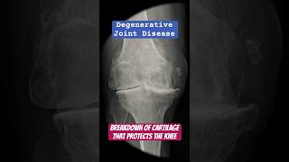 Degenerative arthritis of the knee health arthritis doctor [upl. by Abebi]