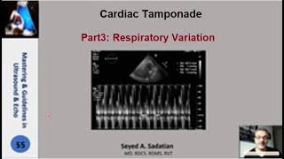 Cardiac tamponade Part 3 Respiratory Variation [upl. by Eatnad]