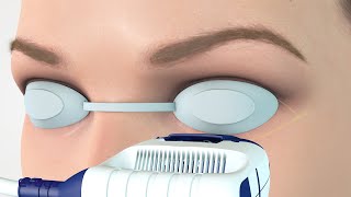 E EYE  Operating mechanism of Dry Eye treatment  EN [upl. by Zurek348]