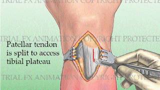 Tibial Fracture repair with Titanium Intramedullary Rod [upl. by Olivann]