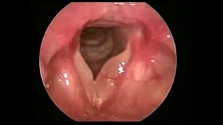 聲帶水腫息肉 Reinkes edema with vocal polyp [upl. by Nolan39]