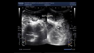 Ultrasound Video showing movements of Bowl contents in Intestinal Obstruction [upl. by Etnaed622]