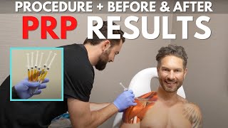 PlateletRich Plasma PRP Injections  Shoulder Impingement Rotator Cuff Injury Treatment Results [upl. by Slin90]