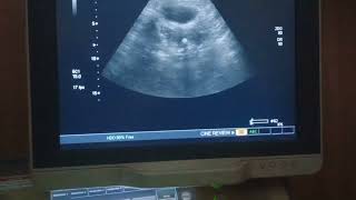 Osseous metaplasia uterus pelvicultrasound pathology [upl. by Fleischer]