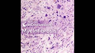 Myelofibrosis Considering TP53 and PostMPN AML [upl. by Frasier]