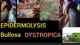 EPIDERMOLYSIS BULLOSA DYSTROPICAAYURVEDA [upl. by Jairia]