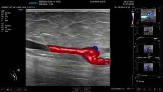 DOPPLER VENOSO Miembros Inferiores con el v7 de Samsung [upl. by Erdnassak]