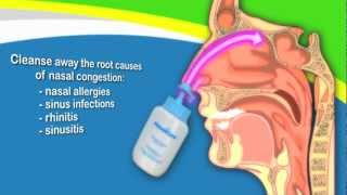 Nasal Irrigation to Treat Sinusitis Common Cold Allergy Better Than Neti Pots [upl. by Scholz]