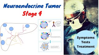 Neuroendocrine Tumor Stage 4 Symptoms Tests Treatment [upl. by Yrtnej]