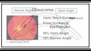 Glaucoma 3 Narrow Angle [upl. by Ecyar]