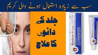 Betaderm N Cream uses in Urdu  Acne Cream Review [upl. by Ahsyad]