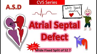 ASD  Atrial Septal Defect  Pathophysiology  Wide Fixed Split S2  Types  Xray ECG  CVS Series [upl. by Kcirederf]