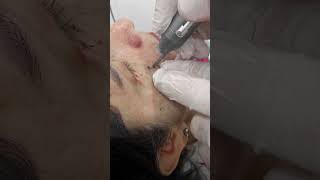 Get rid of unwanted moles with our laser mole removal technique short moleremoval [upl. by Ainav]