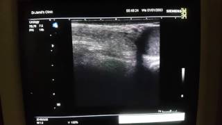 Inguinal Hernia Ultrasound [upl. by Malissia]