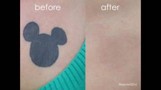 Zapatat Tattoo Removal Video Progression  1 [upl. by Averill]