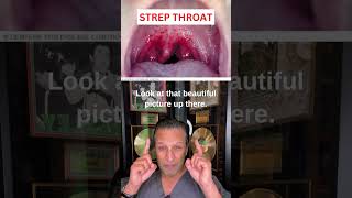 STREP THROAT Symptoms [upl. by Krein375]