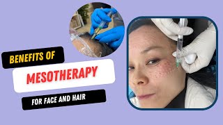 Mesotherapy  Notice facial wrinkles and hair loss when you are 40 [upl. by Marpet]