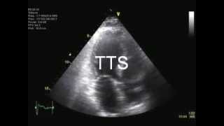 Echocardiographic examination on arrival in acute MI and TakoTsubo cardiomyopathy [upl. by Atiuqam]