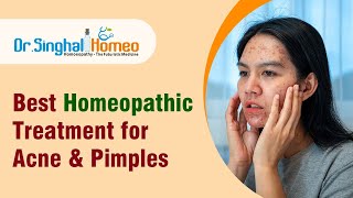 Best Homeopathic Doctor for Acne amp Pimples and Acne Scar Treatment [upl. by Phillane]