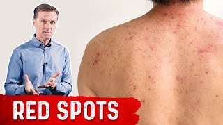 Why Red Spots on My Skin – DrBerg on Skin Red Spots Causes amp Remedies [upl. by Adnovad112]