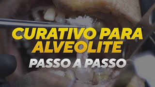 Como fazer um curativo para alveolite [upl. by Curhan620]