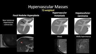 HyperVascular Masses of the Liver [upl. by Marinelli]