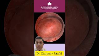 Endometrial Polyp surgery  DrChinmay Pataki  Isha Women’s Hospital  polypterus [upl. by Nannarb]