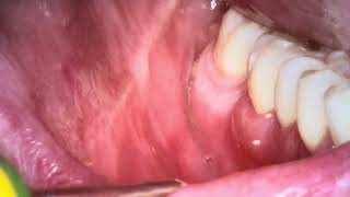 Contact stomatitis oral sores part 113 [upl. by Claresta626]