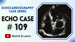 ECHO CASE 109  Echocardiography For Beginners [upl. by Ajtak]