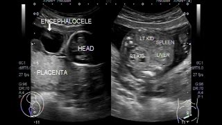 Ultrasound Video showing multiple fetal anomalies [upl. by Hailee]