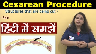 Cesarean Delivery in Hindi  Preoperative Care Procedure Postoperative care  Nursing Lecture [upl. by Nore]