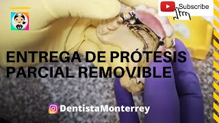 Prótesis DENTAL REMOVIBLE SUPERIOR👅 PPR Ajustes en la Entrega [upl. by Rora]