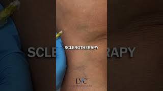 Sclerotherapy surgerysuccess medicaltiktok [upl. by Rakel]