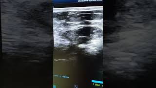 Abdominal wall hernia ultrasound with herniation of omental fat [upl. by Rehotsirhc319]