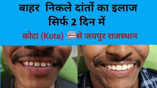 बाहर निकले दांतों का इलाज सिर्फ 2 दिन में Smile design treatmentKota कोटा से जयपुर Rajasthan [upl. by Eimerej]