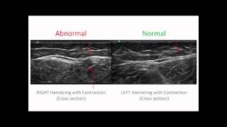 Hamstrings Injury Diagnosis [upl. by Aridaj312]